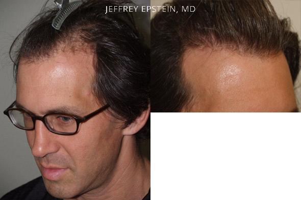 Hair Transplants for Men Before and after in Miami, FL, Paciente 37744