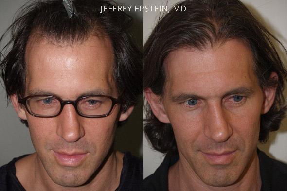 Hair Transplants for Men Before and after in Miami, FL, Paciente 37744