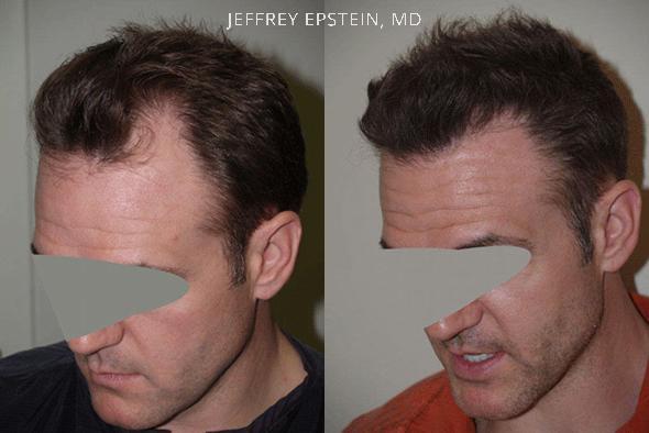 Hair Transplants for Men Before and after in Miami, FL, Paciente 37754