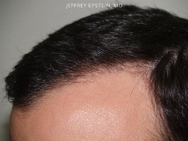 Hair Transplants for Men Before and after in Miami, FL, Paciente 37759