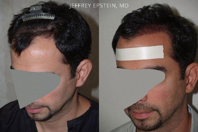 Hair Transplants for Men Before and after in Miami, FL, Paciente 37759