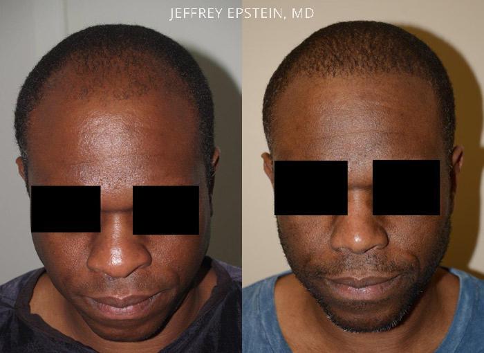 Hair Transplants for Men Before and after in Miami, FL, Paciente 37766