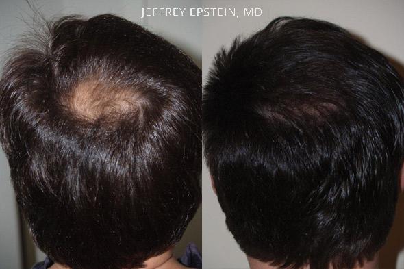 Hair Transplants for Men Before and after in Miami, FL, Paciente 37783