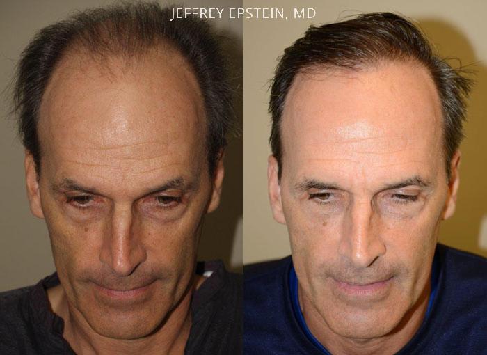 Hair Transplants for Men Before and after in Miami, FL, Paciente 37789