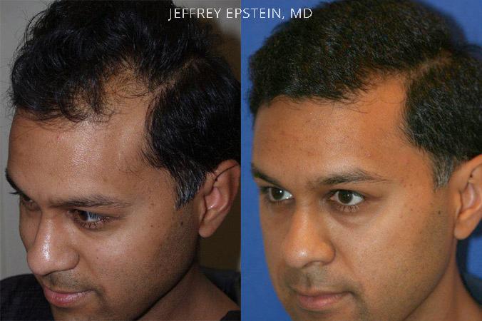 Hair Transplants for Men Before and after in Miami, FL, Paciente 37842