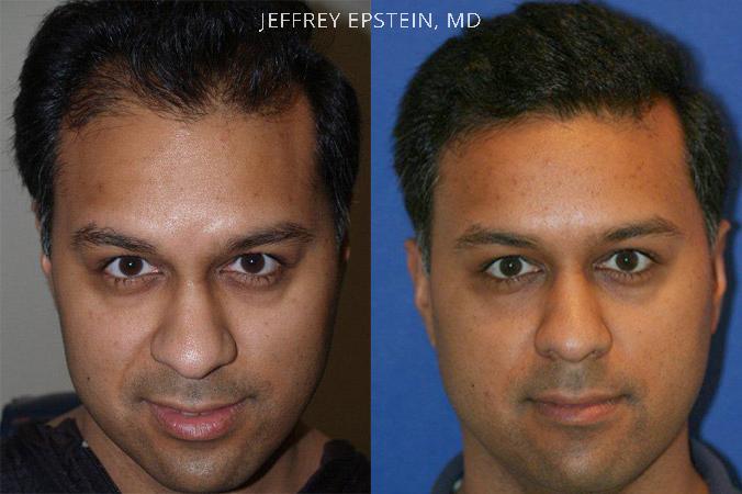 Hair Transplants for Men Before and after in Miami, FL, Paciente 37842