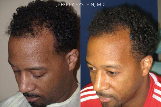 Hair Transplants for Men Before and after in Miami, FL, Paciente 37847
