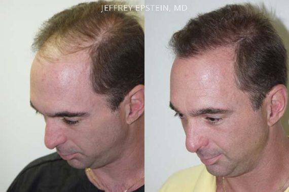 Hair Transplants for Men Before and after in Miami, FL, Paciente 37852