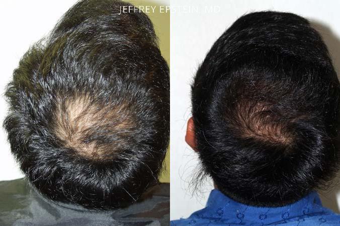Hair Transplants for Men Before and after in Miami, FL, Paciente 37857
