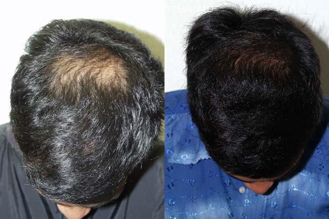 Hair Transplants for Men Before and after in Miami, FL, Paciente 37857