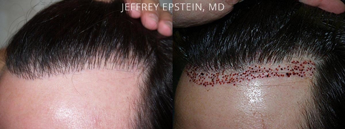 Hair Transplants for Men Before and after in Miami, FL, Paciente 37862