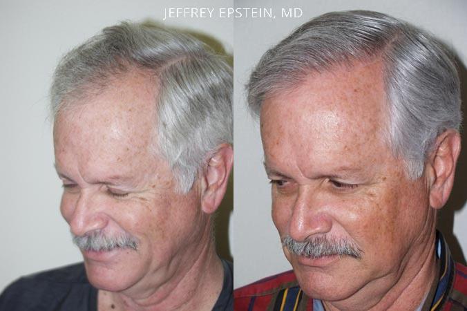 Hair Transplants for Men Before and after in Miami, FL, Paciente 37877