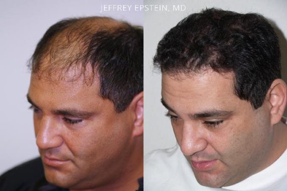 Trasplante de Pelo en Hombres Before and after in Miami, FL, Paciente 87892