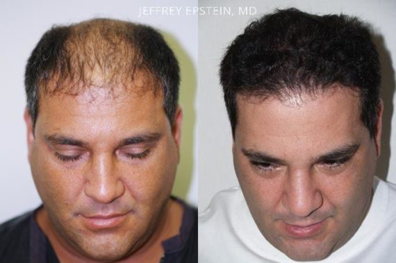 Trasplante de Pelo en Hombres Before and after in Miami, FL, Paciente 87892