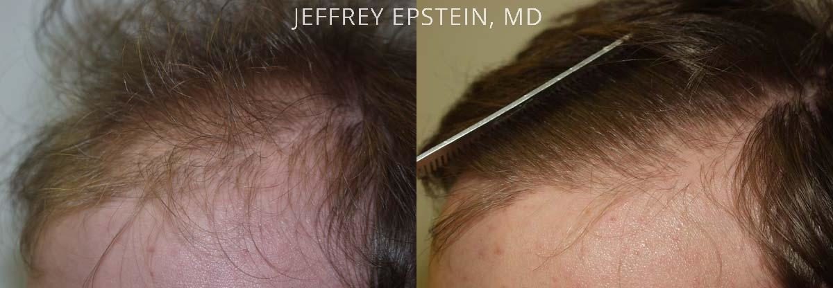 Hair Transplants for Men Before and after in Miami, FL, Paciente 37890