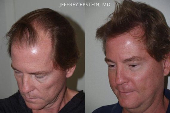 Trasplante de Pelo en Hombres Before and after in Miami, FL, Paciente 87793
