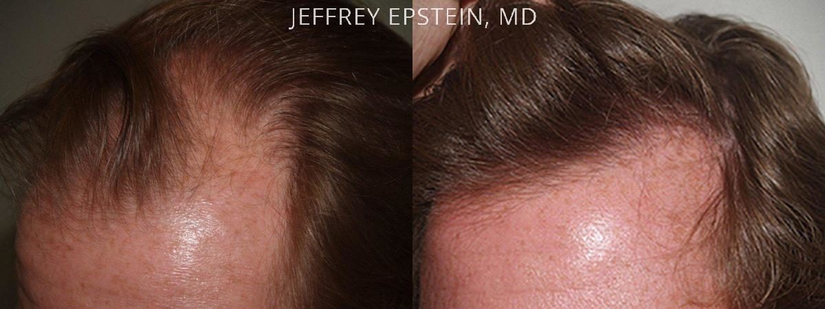 Hair Transplants for Men Before and after in Miami, FL, Paciente 37897