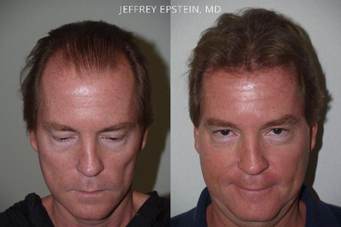 Trasplante de Pelo en Hombres Antes y después en Miami, FL, Paciente 87793