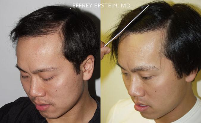 Hair Transplants for Men Before and after in Miami, FL, Paciente 37905