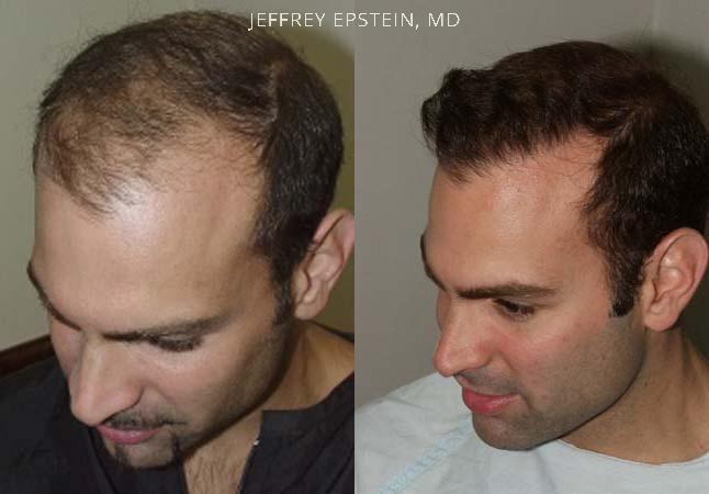 Hair Transplants for Men Before and after in Miami, FL, Paciente 37915