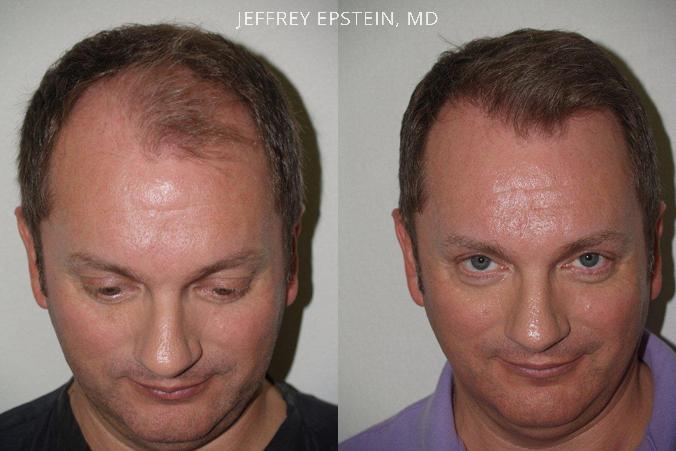 Trasplante de Pelo en Hombres Antes y después en Miami, FL, Paciente 87669