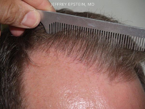 Hair Transplants for Men Before and after in Miami, FL, Paciente 37920