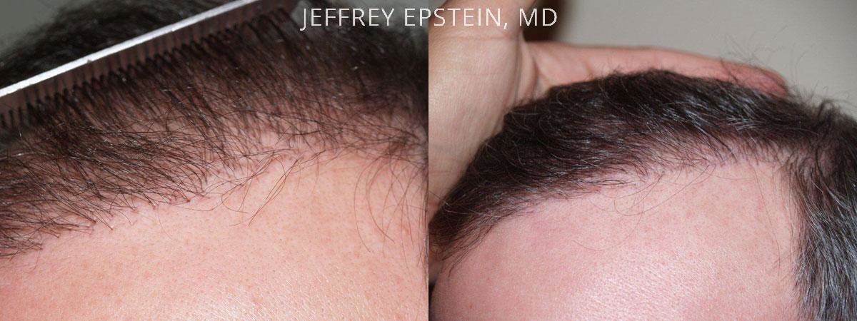 Hair Transplants for Men Before and after in Miami, FL, Paciente 37930