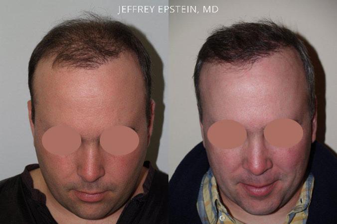 Hair Transplants for Men Before and after in Miami, FL, Paciente 37930