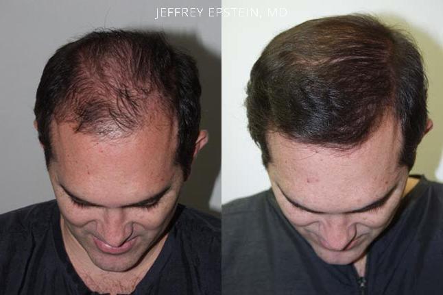 Hair Transplants for Men Before and after in Miami, FL, Paciente 37935