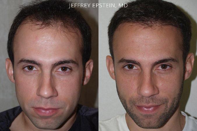 Hair Transplants for Men Before and after in Miami, FL, Paciente 37945