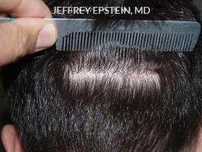 Hair Transplants for Men Before and after in Miami, FL, Paciente 37952