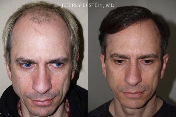 Hair Transplants for Men Before and after in Miami, FL, Paciente 37952