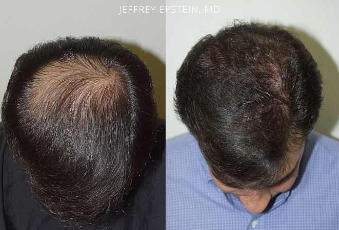 Hair Transplants for Men Before and after in Miami, FL, Paciente 37962