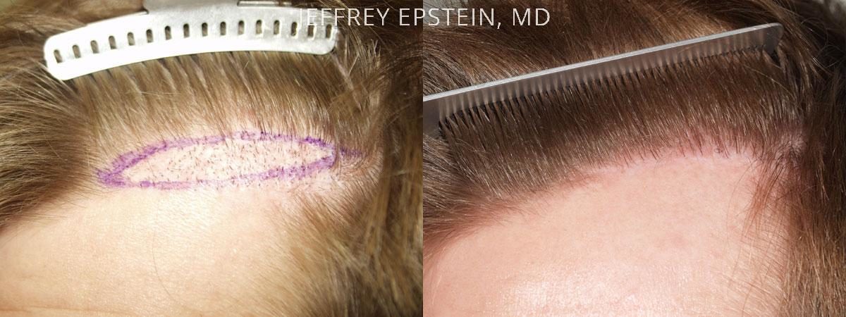 Hair Transplants for Men Before and after in Miami, FL, Paciente 37965