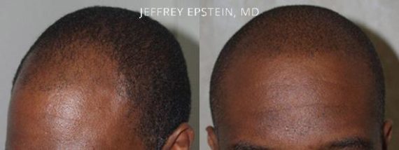 Trasplante de Pelo en Hombres Before and after in Miami, FL, Paciente 87274