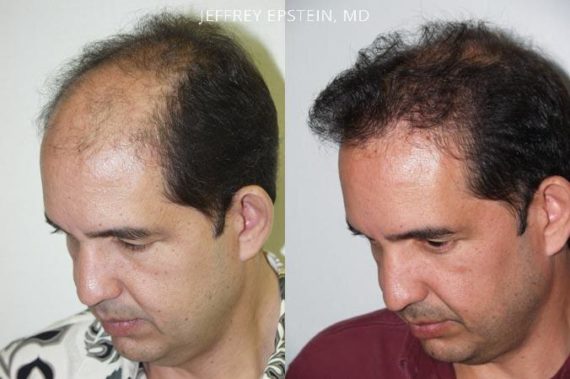 Trasplante de Pelo en Hombres Before and after in Miami, FL, Paciente 87212