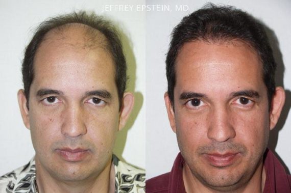 Trasplante de Pelo en Hombres Before and after in Miami, FL, Paciente 87212