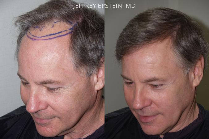 Hair Transplants for Men Before and after in Miami, FL, Paciente 37995