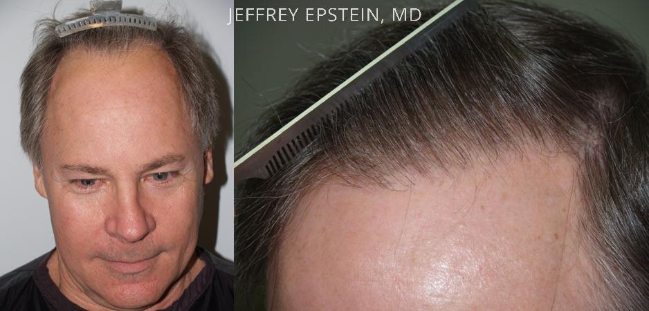 Hair Transplants for Men Before and after in Miami, FL, Paciente 37995
