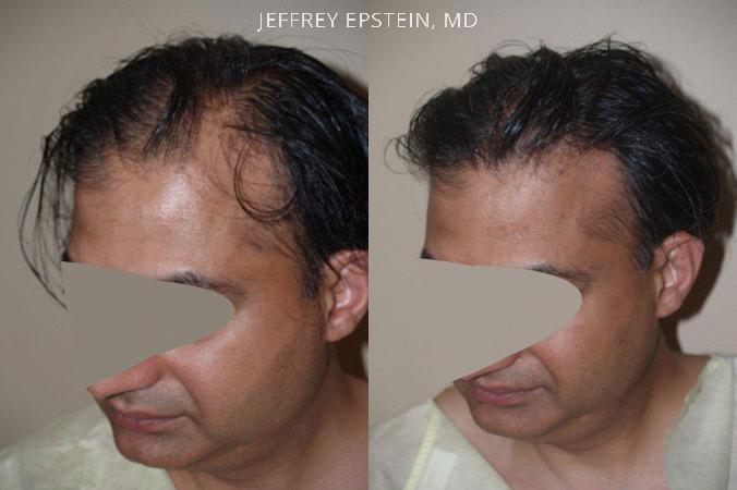 Hair Transplants for Men Before and after in Miami, FL, Paciente 38004