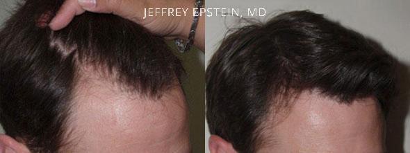 Hair Transplants for Men Before and after in Miami, FL, Paciente 38023