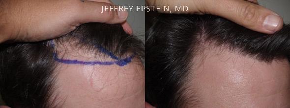 Hair Transplants for Men Before and after in Miami, FL, Paciente 38023