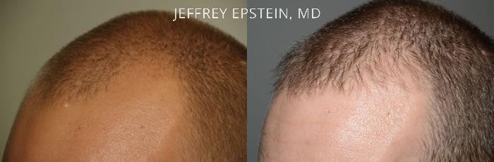 Hair Transplants for Men Before and after in Miami, FL, Paciente 38052