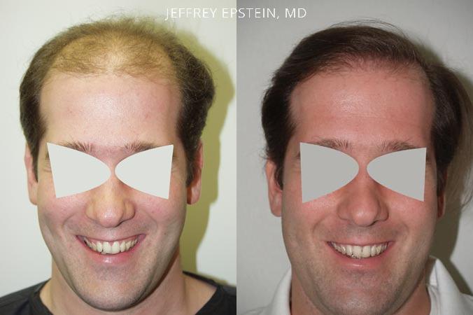 Hair Transplants for Men Before and after in Miami, FL, Paciente 38059