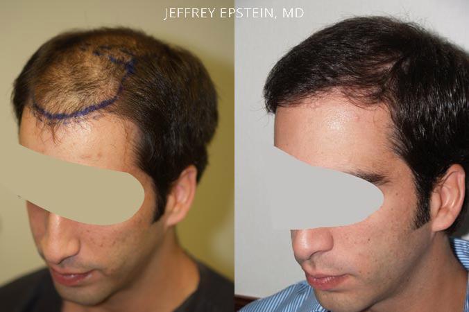 Hair Transplants for Men Before and after in Miami, FL, Paciente 38083