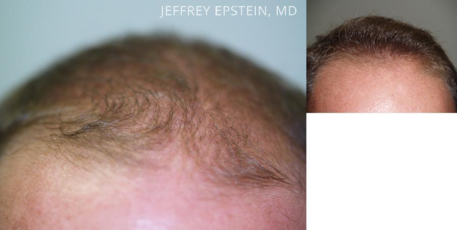 Hair Transplants for Men Before and after in Miami, FL, Paciente 38087