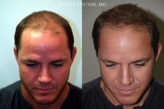 Trasplante de Pelo en Hombres Before and after in Miami, FL, Paciente 86700