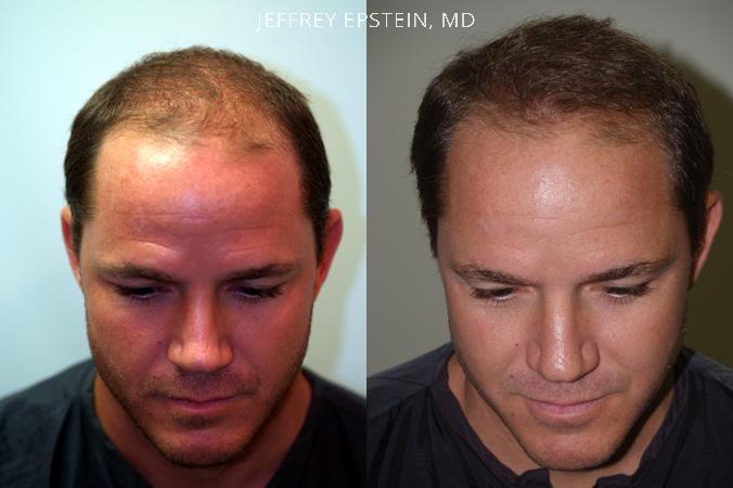 Hair Transplants for Men Before and after in Miami, FL, Paciente 38087