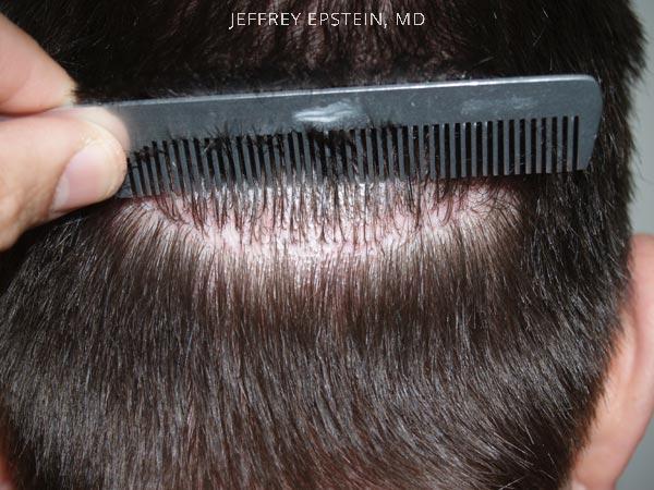 Hair Transplants for Men Before and after in Miami, FL, Paciente 38094