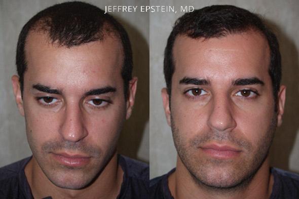 Hair Transplants for Men Before and after in Miami, FL, Paciente 38103